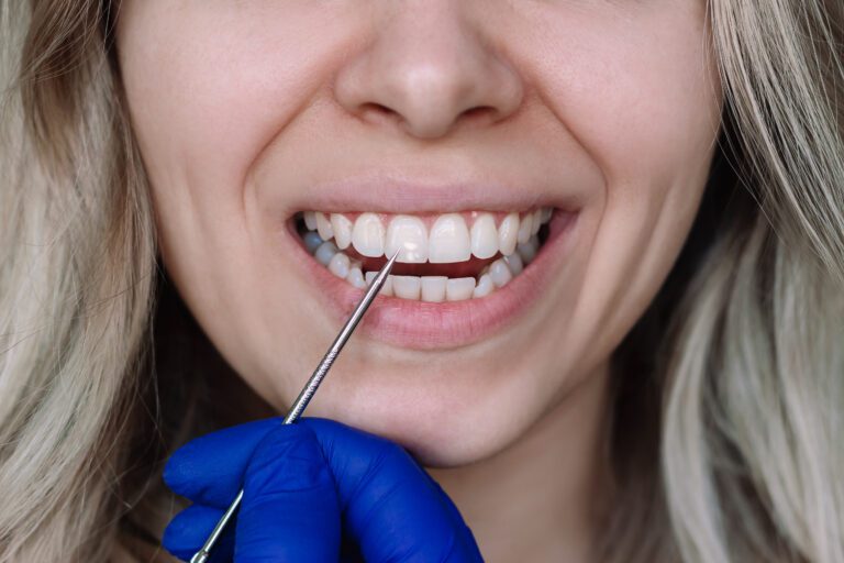 white spots on teeth Cosmetic dentistry in Chicago