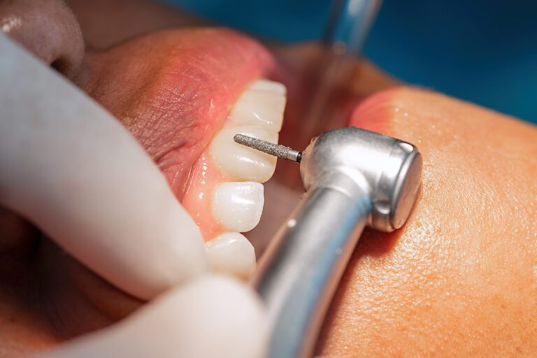 full mouth reconstruction Cosmetic Dentistry in Chicago