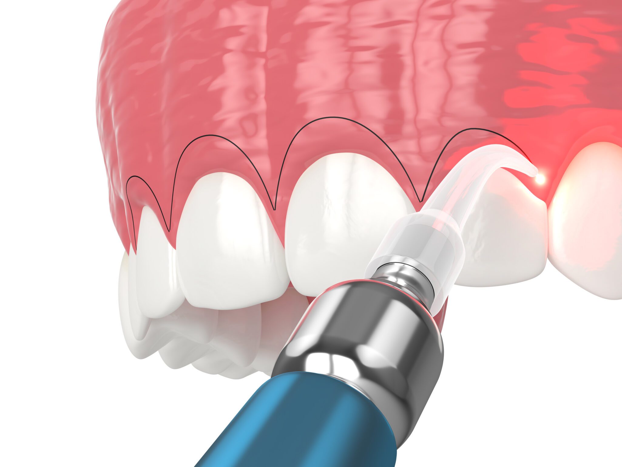laser gum contouring Cosmetic Dentistry in Chicago