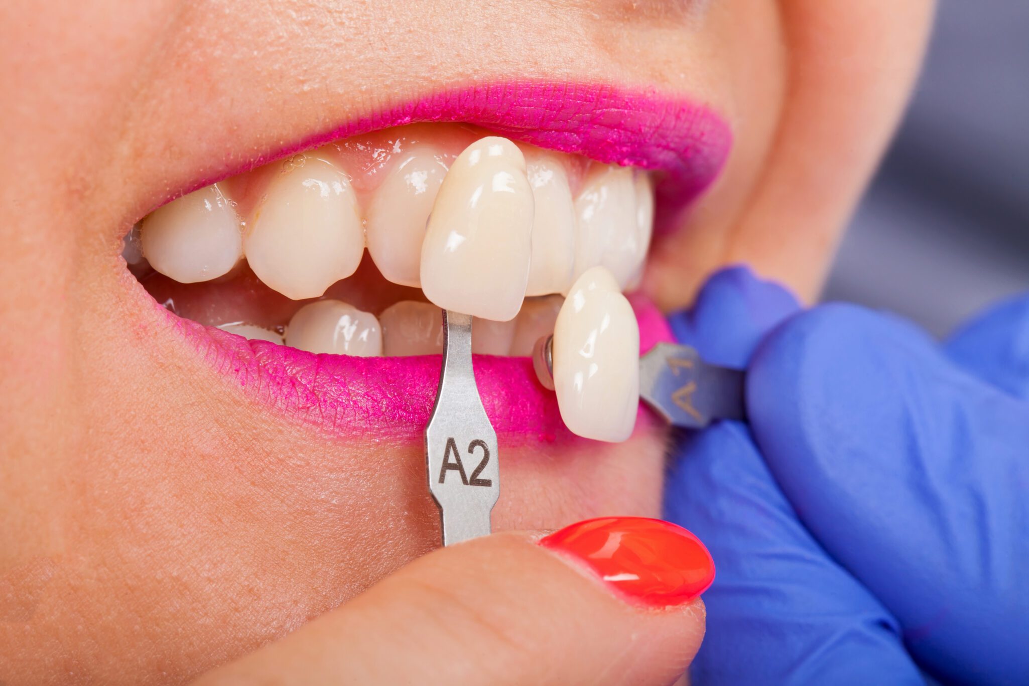 Smile Makeover in Chicago