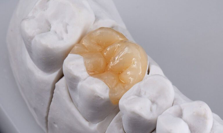 dental inlay General Dentistry in Chicago